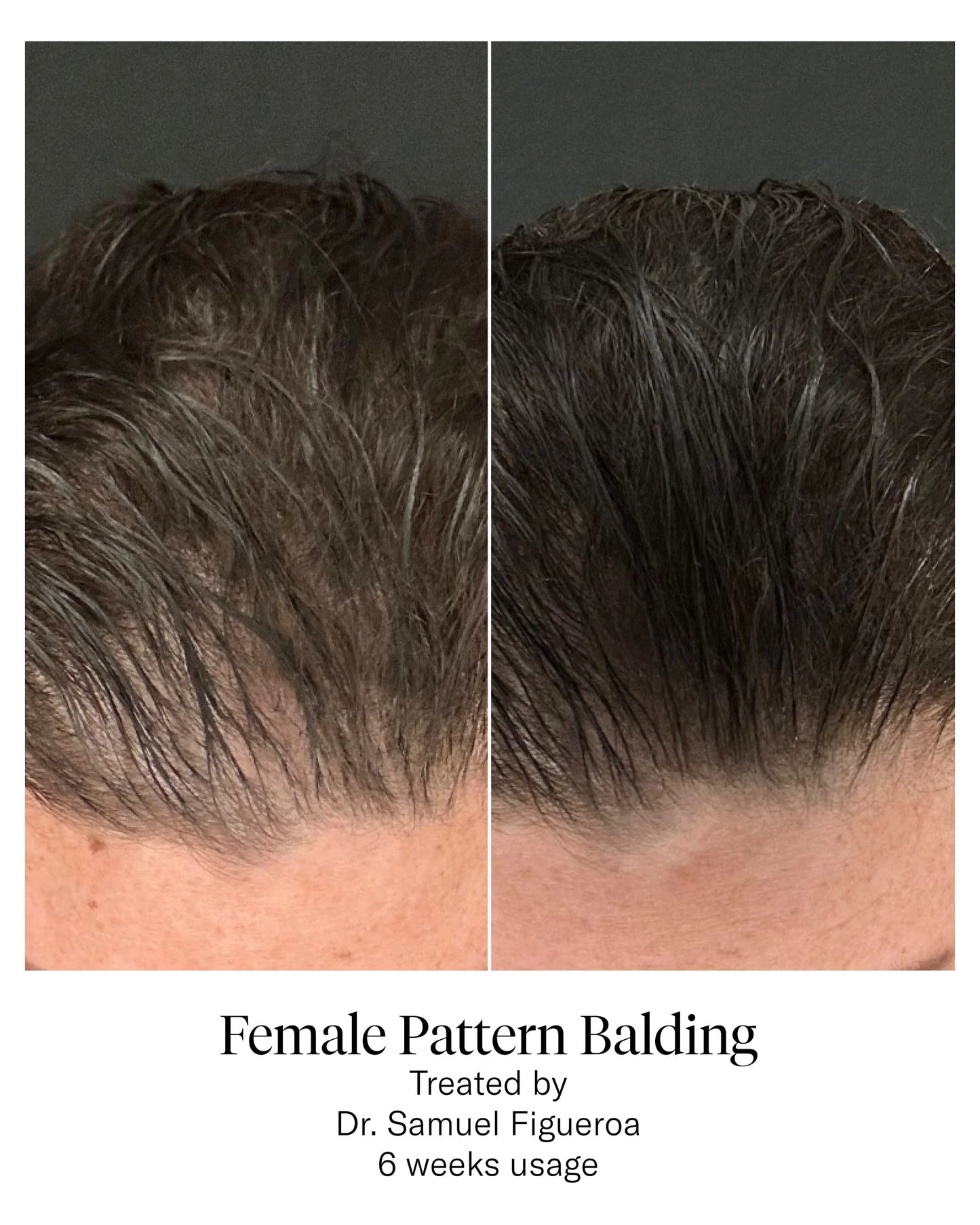 Calecim Serum Capilar - 6 semanas