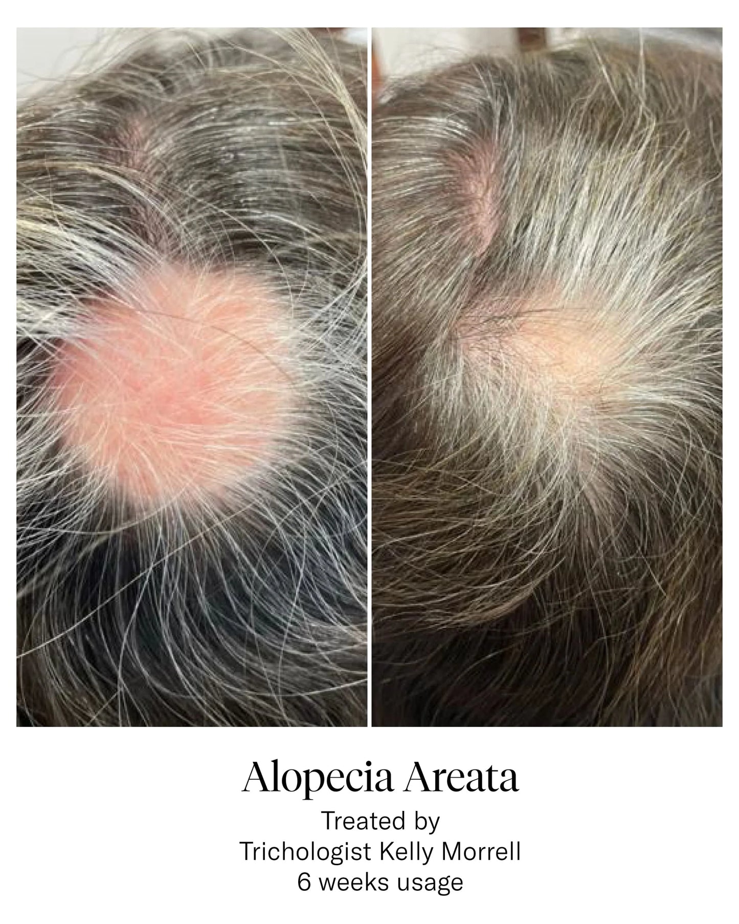 Calecim Serum Capilar - 6 semanas