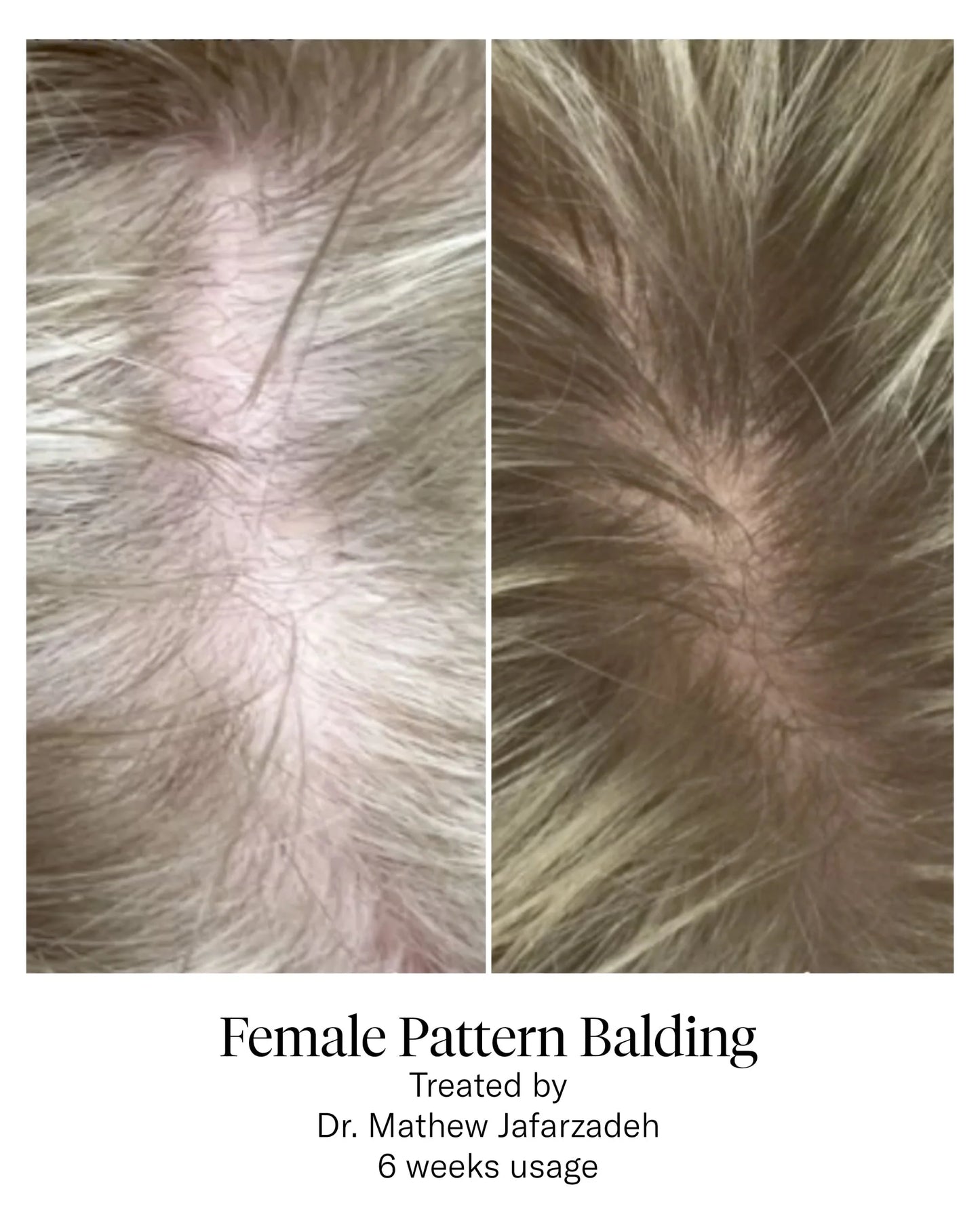 Calecim Serum Capilar - 6 semanas
